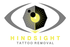 Hindsight Tattoo Removal